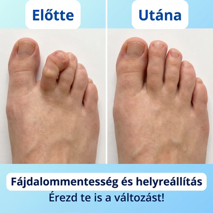 Toesy™ - Lábujj Kiegyenesítő - Páros Kiszerelés